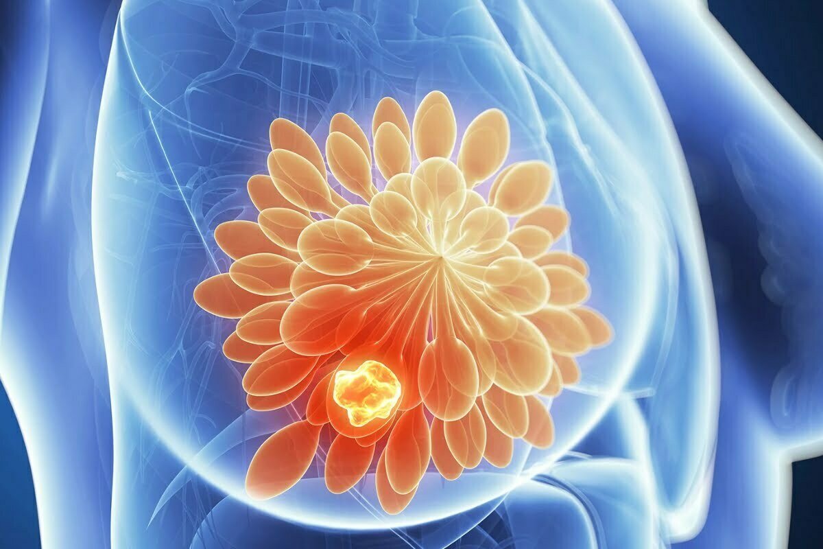 ASCO 2023: Revolutionary SERM Breaks Ground in Treating Previously Treated ESR1 ER+/HER2-Metastatic Breast Cancer Patients
