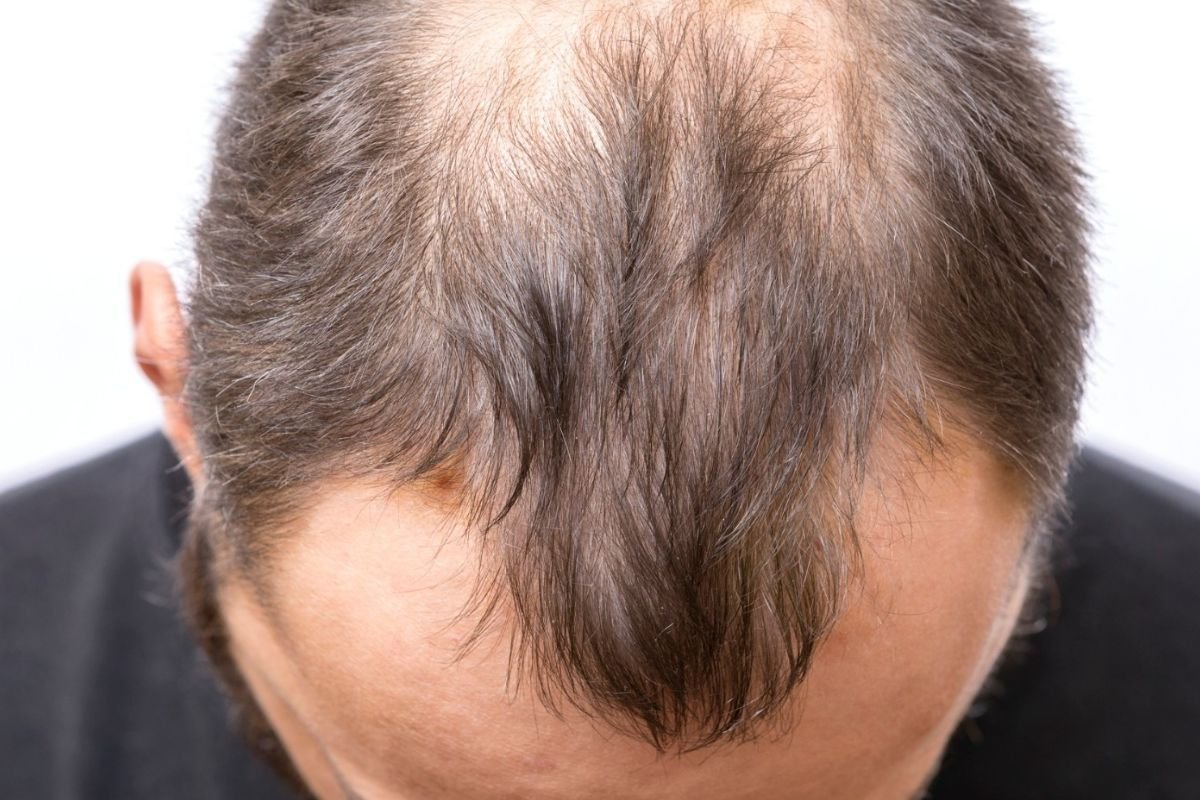 FDA Grants Approval to Pfizer's LITFULO (Ritlecitinib) for Severe Alopecia Areata