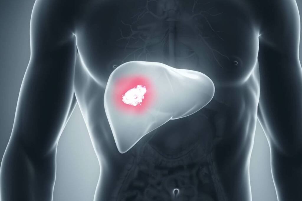 Initiation of Treatment with TTI-101, Either Alone or in Combination with Standard Targeted Therapy, in Advanced Hepatocellular Carcinoma _ Pharmtales - Latest Pharma News & Insights