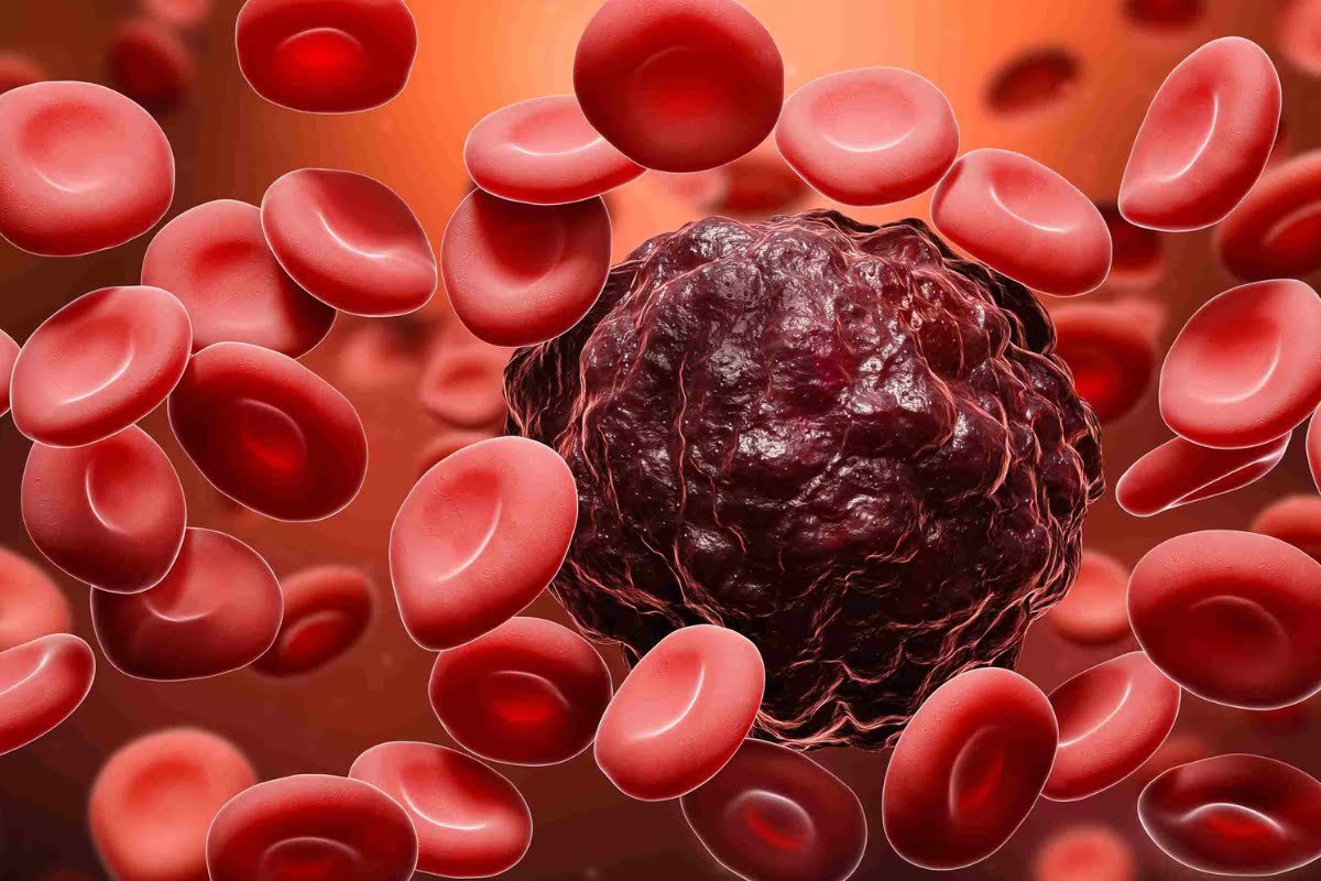 Ziftomenib: A Promising New Treatment for NPM1-Mutated Acute Myeloid Leukemia