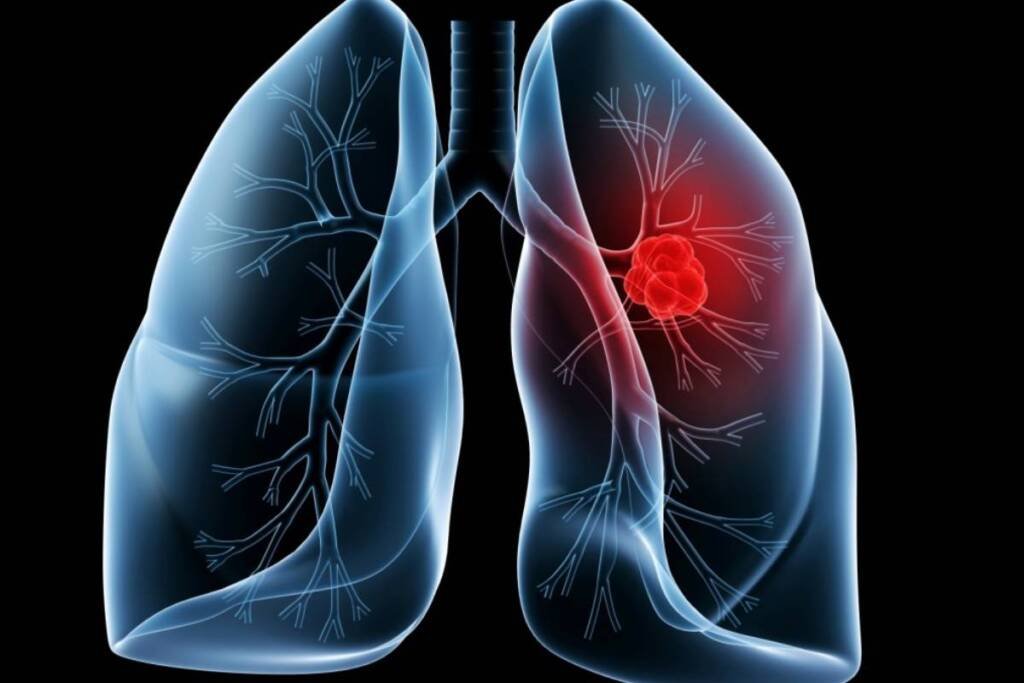 lung-cancer-stage-3-survival-rate - Pharmtales - Latest Pharma News & Analysis