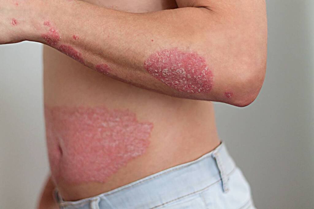 BMS' Sotyktu is approved for psoriasis usage by the NHS | Pharmtales