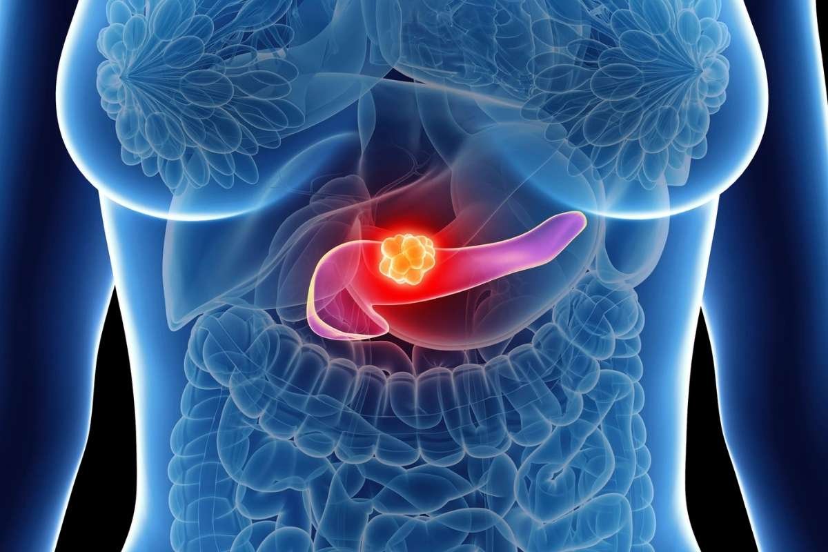 PANOVA-3 Trial Tests TTFields for Pancreatic Cancer Survival