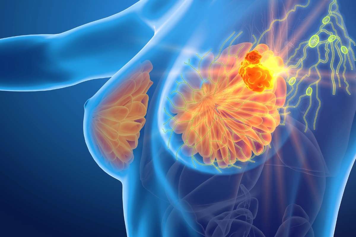 Enhertu Receives Approval in China as Groundbreaking HER2-Directed Therapy for HER2-Low Metastatic Breast Cancer Patients