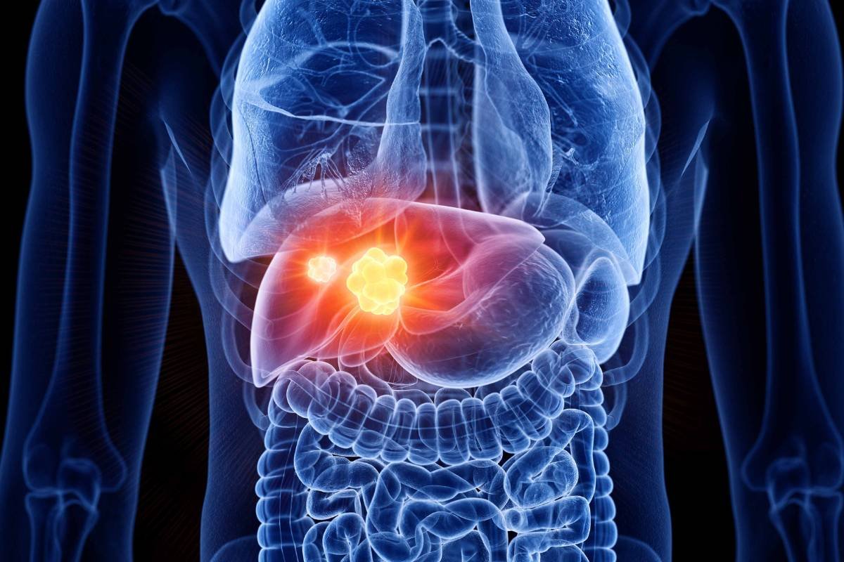 Imfinzi + Imjudo Unprecedented 4-Year Survival in Advanced Liver Cancer | Pharmtales