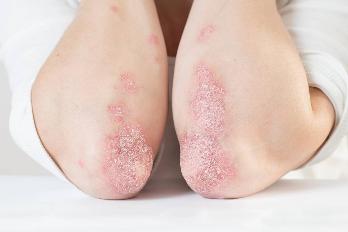 Janssen rejoices at JNJ-2113A's successful psoriasis study findings