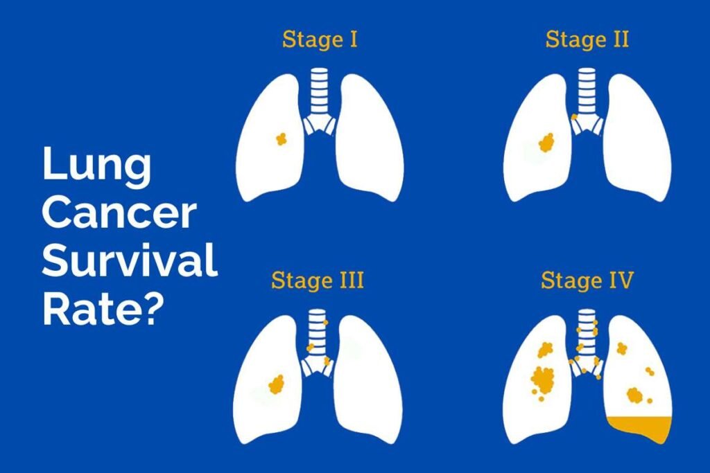 What is the Lung Cancer Stage 3 Survival Rate?