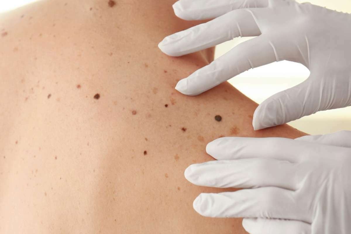 New Vaccine Combo May Cure Deadly Melanoma