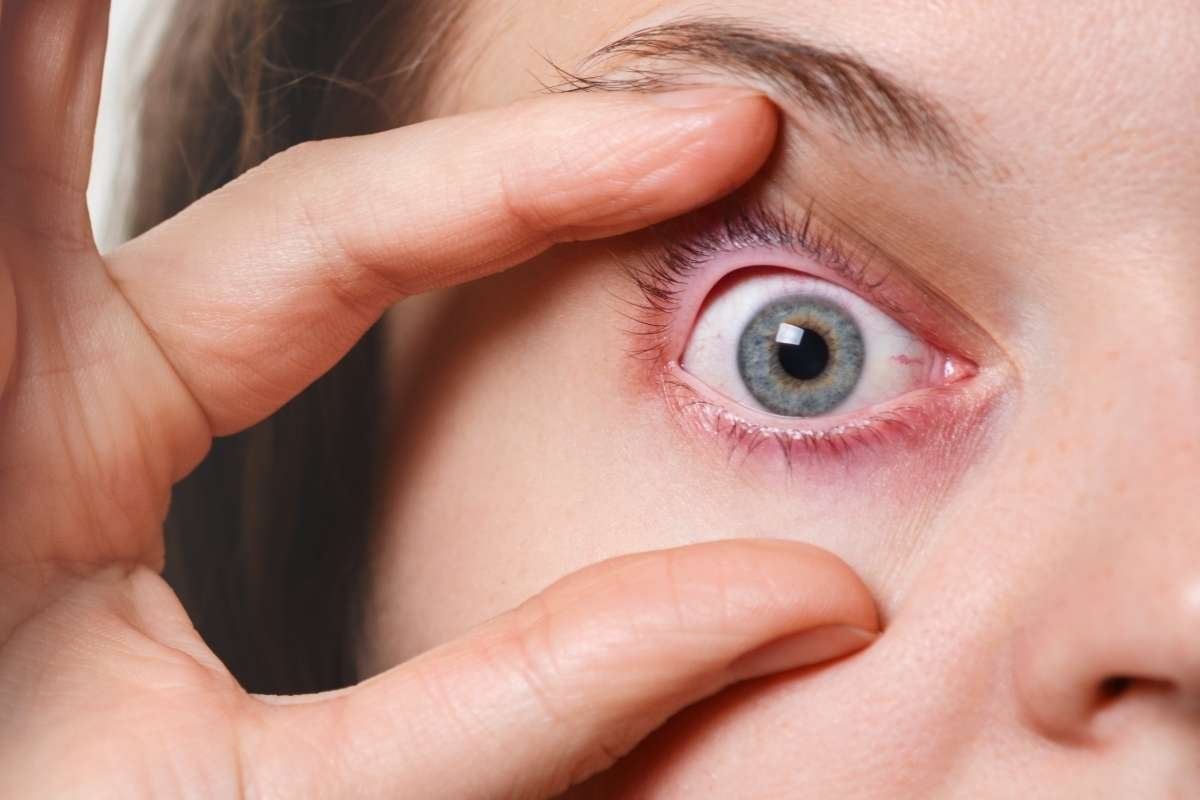 FDA Approves Xdemvy: Breakthrough for Eyelid Disease