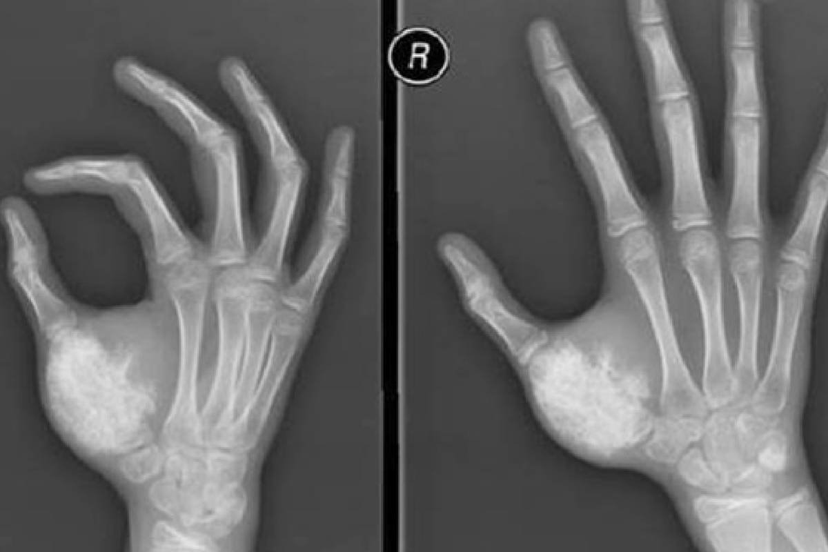 Treatment of Ewing Sarcoma - Pharmtales