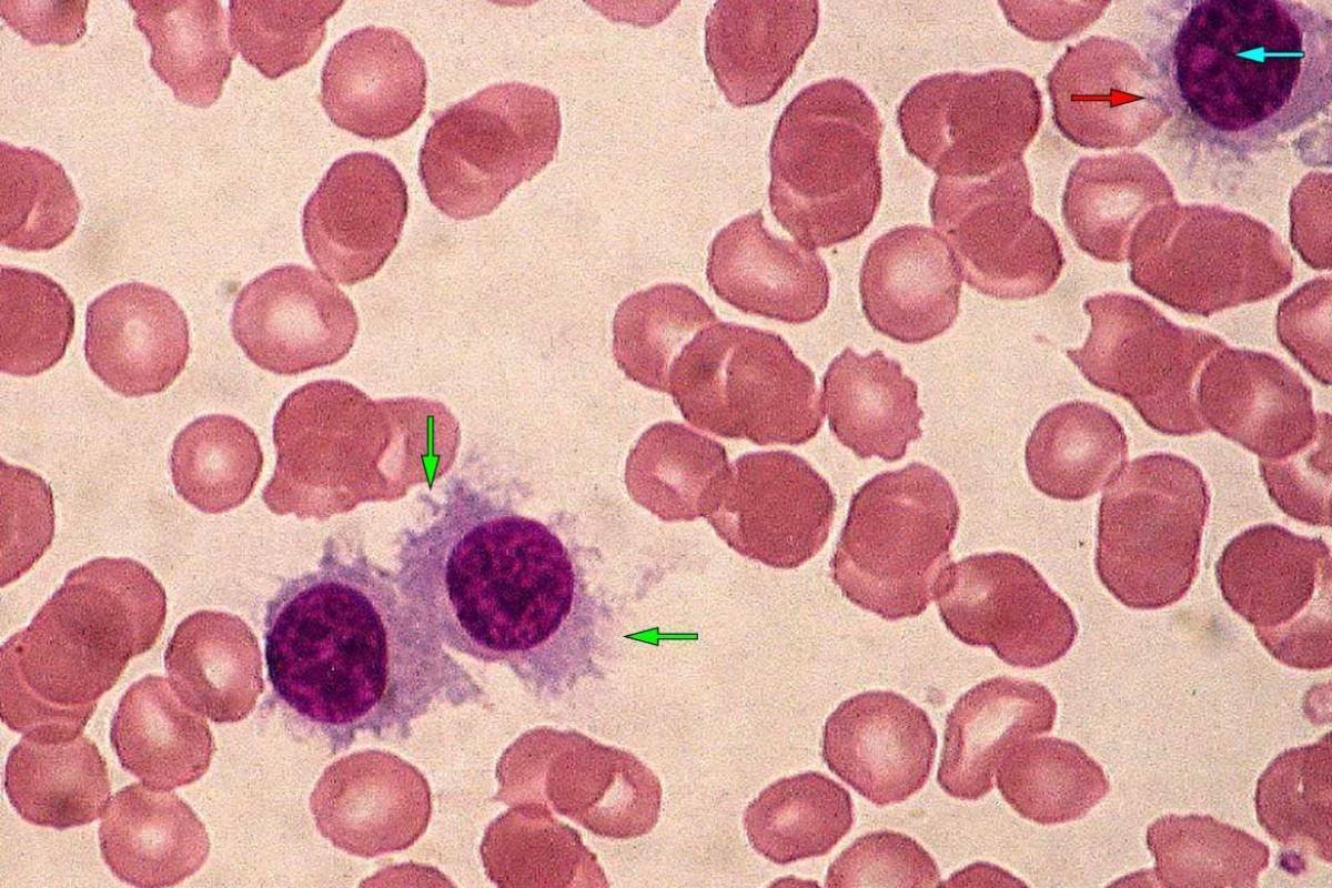 relapsed-refractory-marginal-zone-lymphoma-reacts-abivertinib