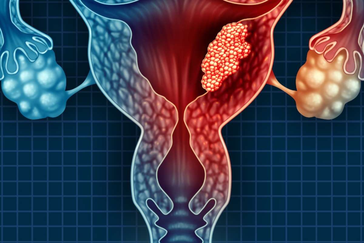Jemperli Approved for First-Line Endometrial Cancer Therapy