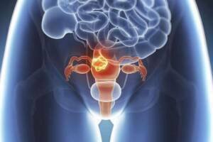 Endometrial Cancer: Symptoms, Risks, and Treatments