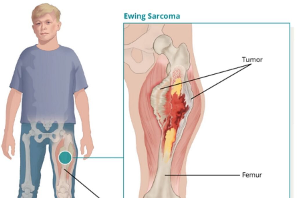 Ewing Sarcoma Cancer, Ewing Sarcoma Cancer Treatments, Treatment of Ewing Sarcoma