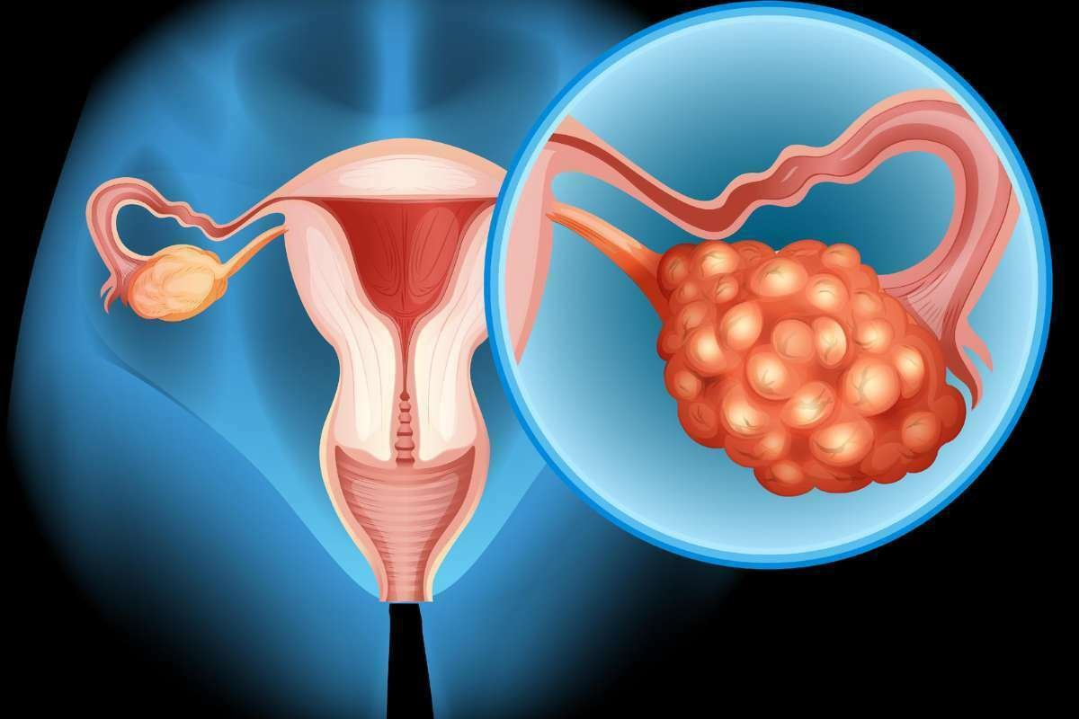 Upifitamab Rilsodotin Fails in Ovarian Cancer Trial