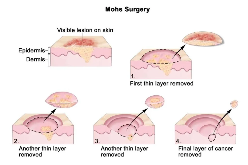 Soft Tissue Sarcoma Symptoms Types Causes Treatment And More