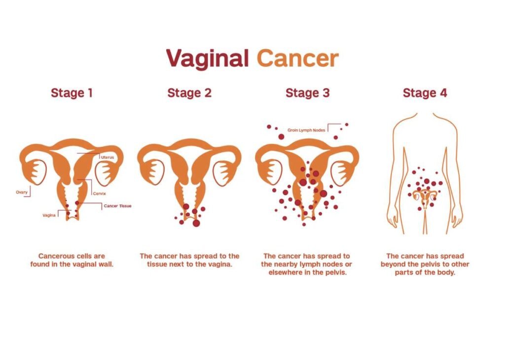 Stages of vaginal cancer - Vaginal Cancer - A Comprehensive Guide to Symptoms, Types, Causes, Treatment and More