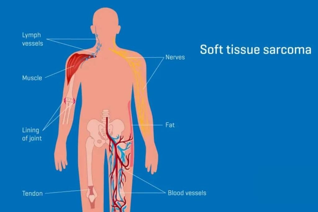 types of soft tissue sarcoma - Soft Tissue Sarcoma_ A Rare and Challenging Cancer