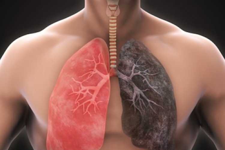 Bristol Myers Squibb, pulmonary fibrosis, idiopathic pulmonary fibrosis, BMS-986278, Phase 2 results