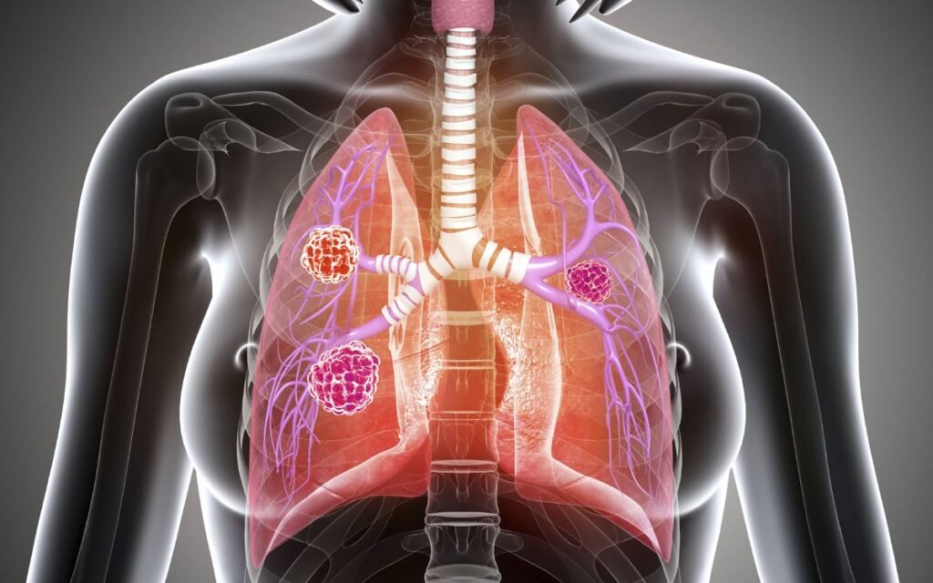 ESMO 2023: Opdivo + Chemo Boosts Survival in Resectable NSCLC