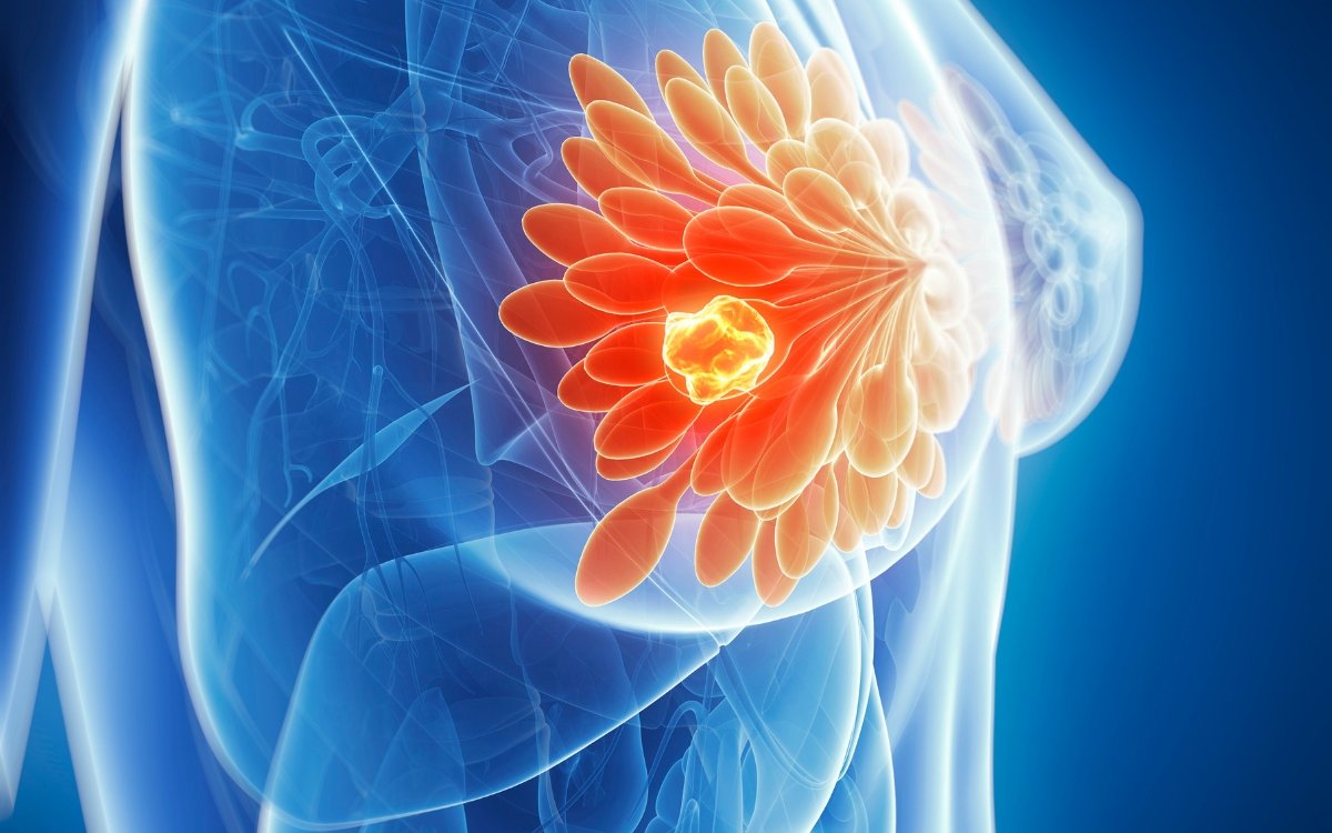 ESMO 2023: Keytruda + Chemo Boosts pCR in ER+/HER2– Breast Cancer
